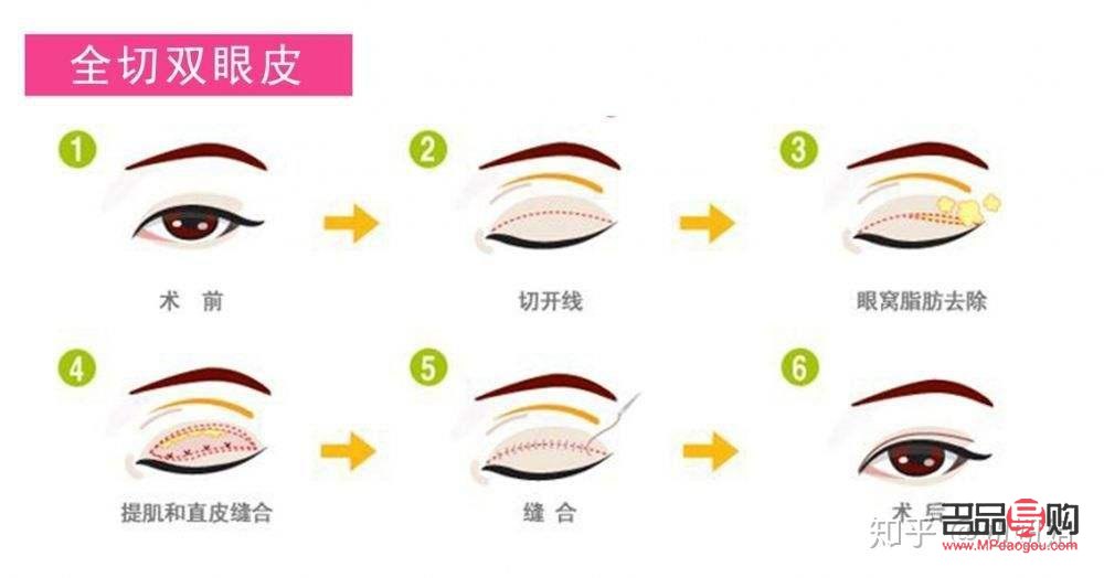 埋眼线与割双眼皮：哪个更适合你？