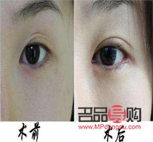 <h3>纳米双眼皮与埋线的区别详解</h3>
