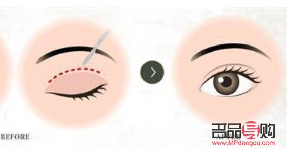 <h3>纳米双眼皮与埋线的区别详解</h3>