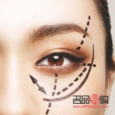 双眼皮埋线图片 恢复(双眼皮埋线图片 恢复过程)