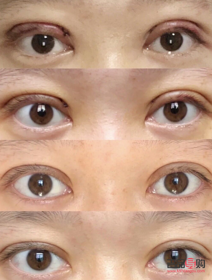 开眼角加割双眼皮要多少钱(开眼角加割双眼皮要多少钱费用)