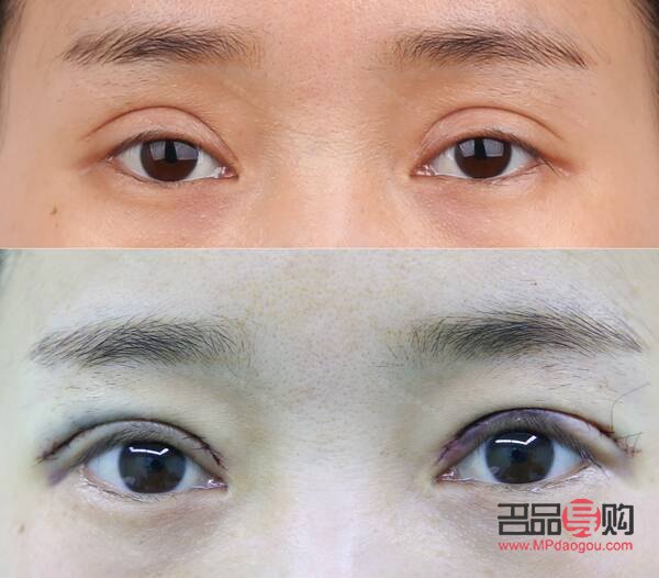 开眼角加割双眼皮要多少钱(开眼角加割双眼皮要多少钱费用)