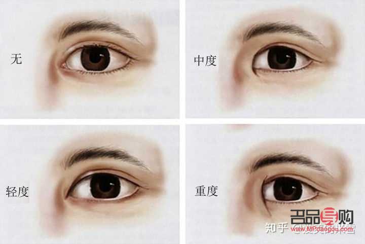 开眼角加割双眼皮要多少钱(开眼角加割双眼皮要多少钱费用)