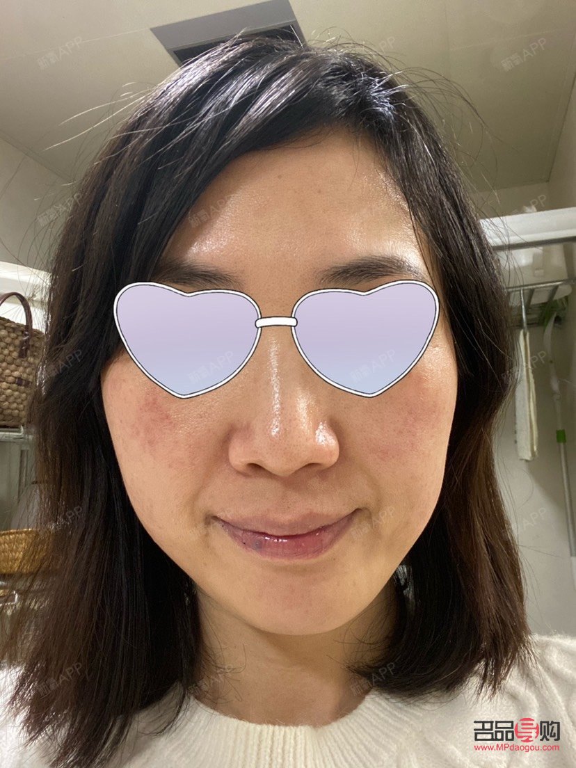 眼部热拉提做后会肿吗(眼部热拉提做后会肿吗) 眼部热拉提做后会肿吗(眼部热拉提做后会肿吗)