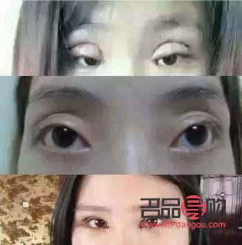 双眼皮美学：探索不同的双眼皮形态