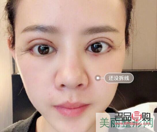 <h3>双眼皮做宽了能否修复？</h3>