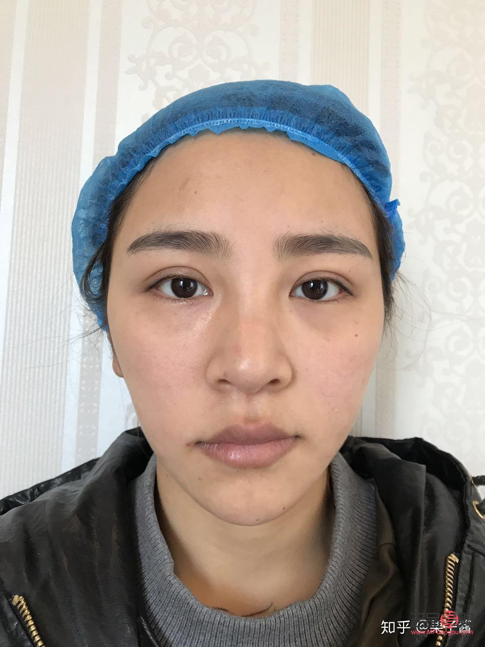 <h3>双眼皮做宽了能否修复？</h3>