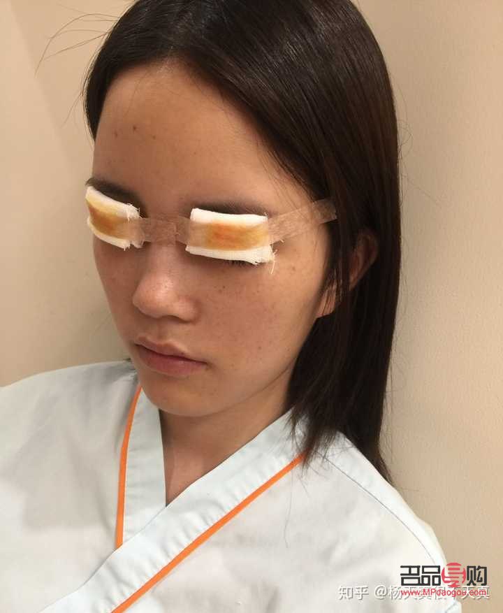 双眼皮做宽了能否修复？