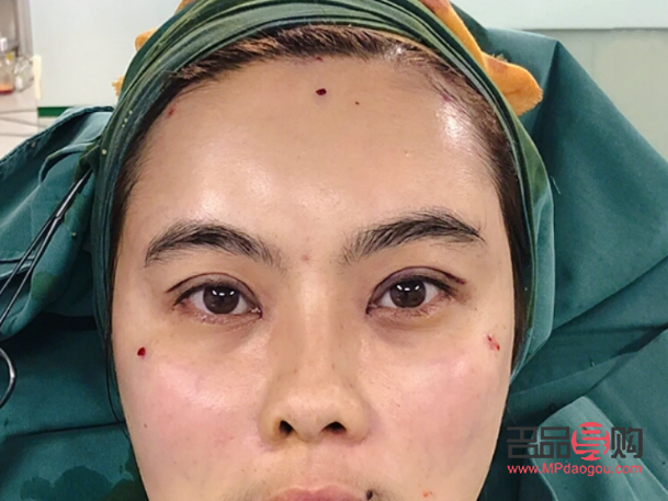 微整眼部(微整眼部提拉后的感觉)