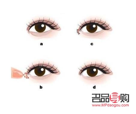 开完眼角是否能恢复到以前？