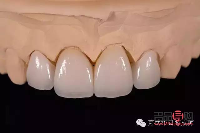 <h3>美容冠危害深度解析</h3>