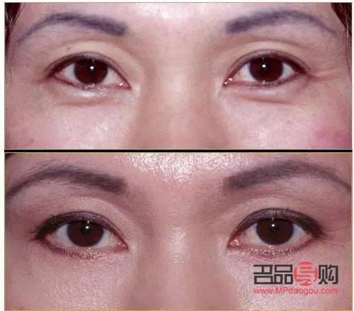 眼袋里面脂肪怎么疏通(眼袋里面脂肪怎么疏通经络)