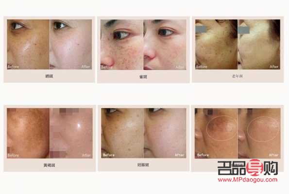 激光美容祛斑好吗(激光美容祛斑好吗多少钱)