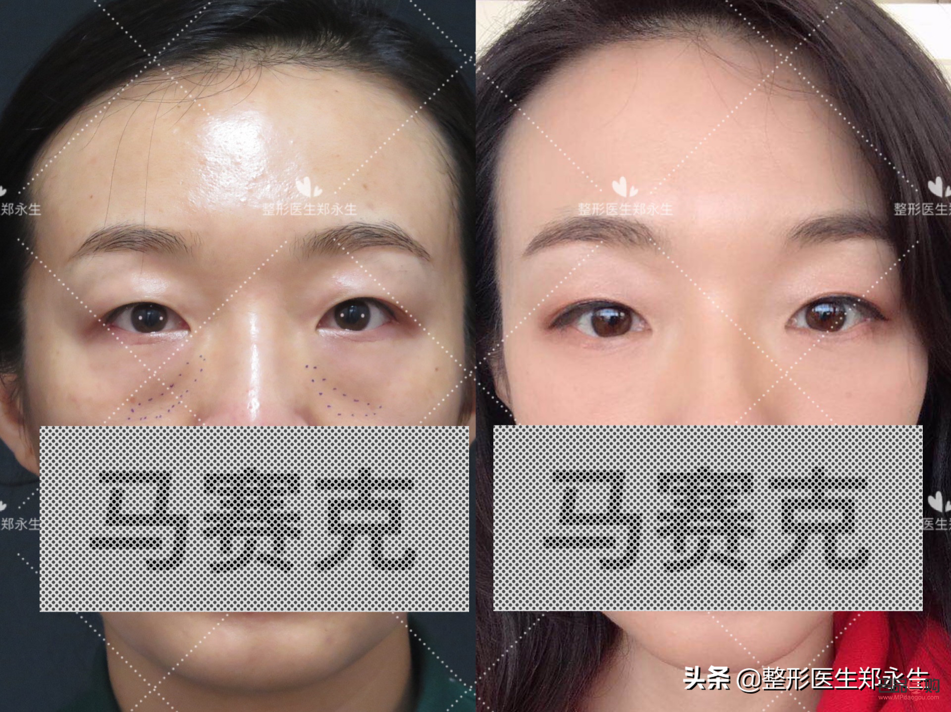 眼袋怎么治疗最有效果(眼袋怎么治疗最有效果图片)