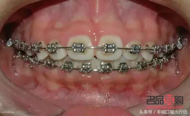 什么是美容牙(什么是美容牙冠)