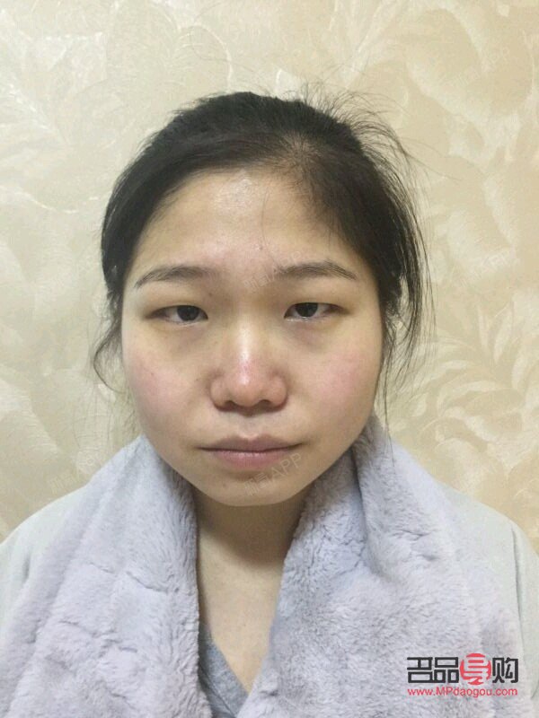 <h3>解决单眼皮下垂的有效方法</h3>