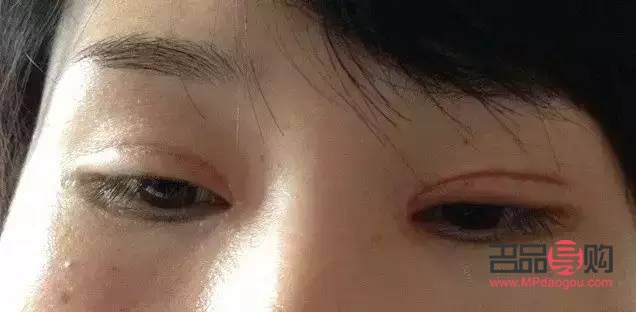 假性双眼皮怎么变成双眼皮(假性双眼皮怎么变成双眼皮了)