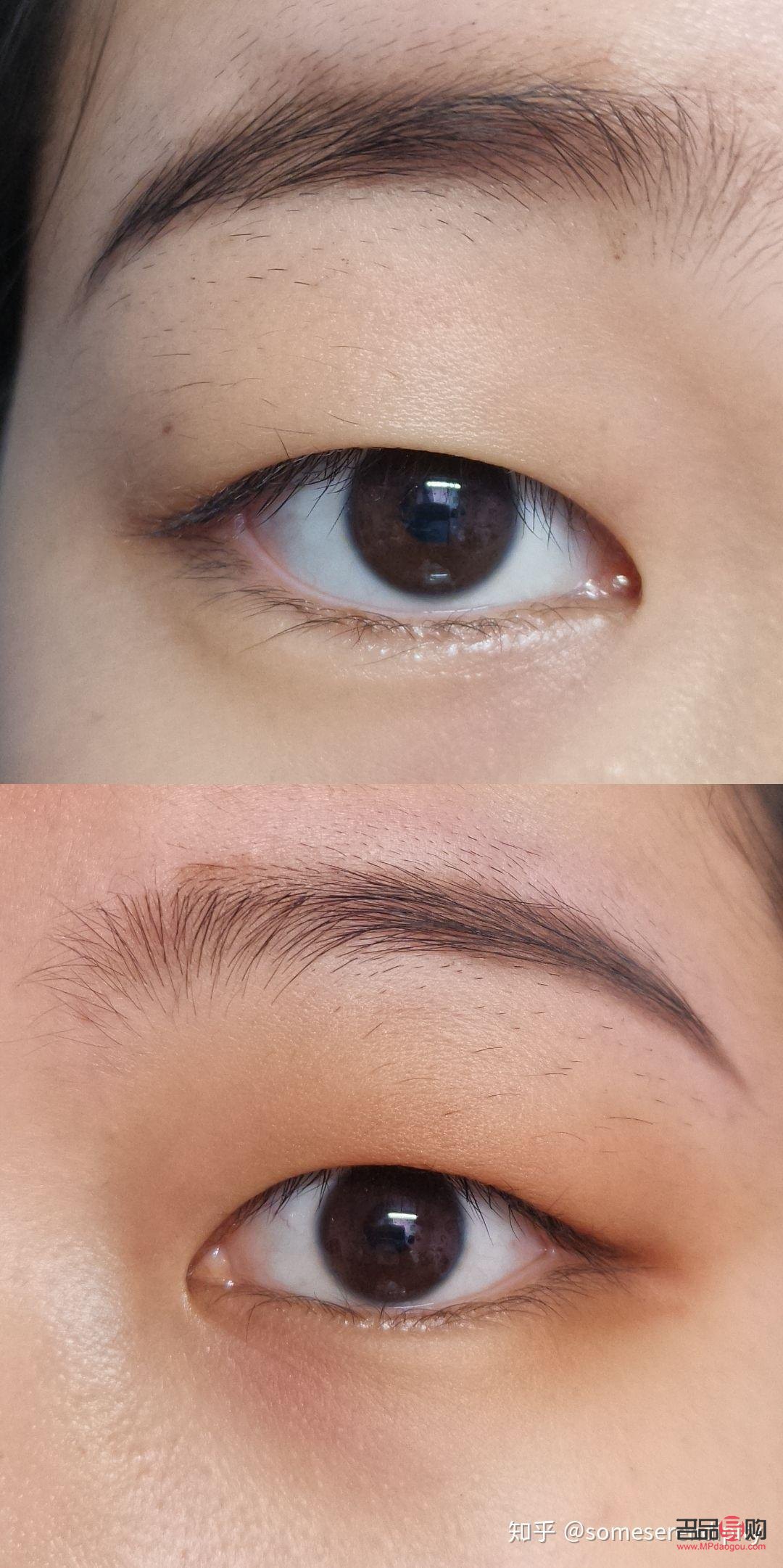 肿眼泡怎么改善(单眼皮肿眼泡怎么改善)