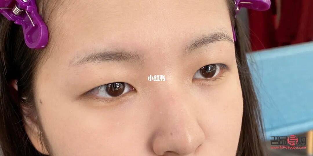 肿眼泡怎么改善(单眼皮肿眼泡怎么改善)