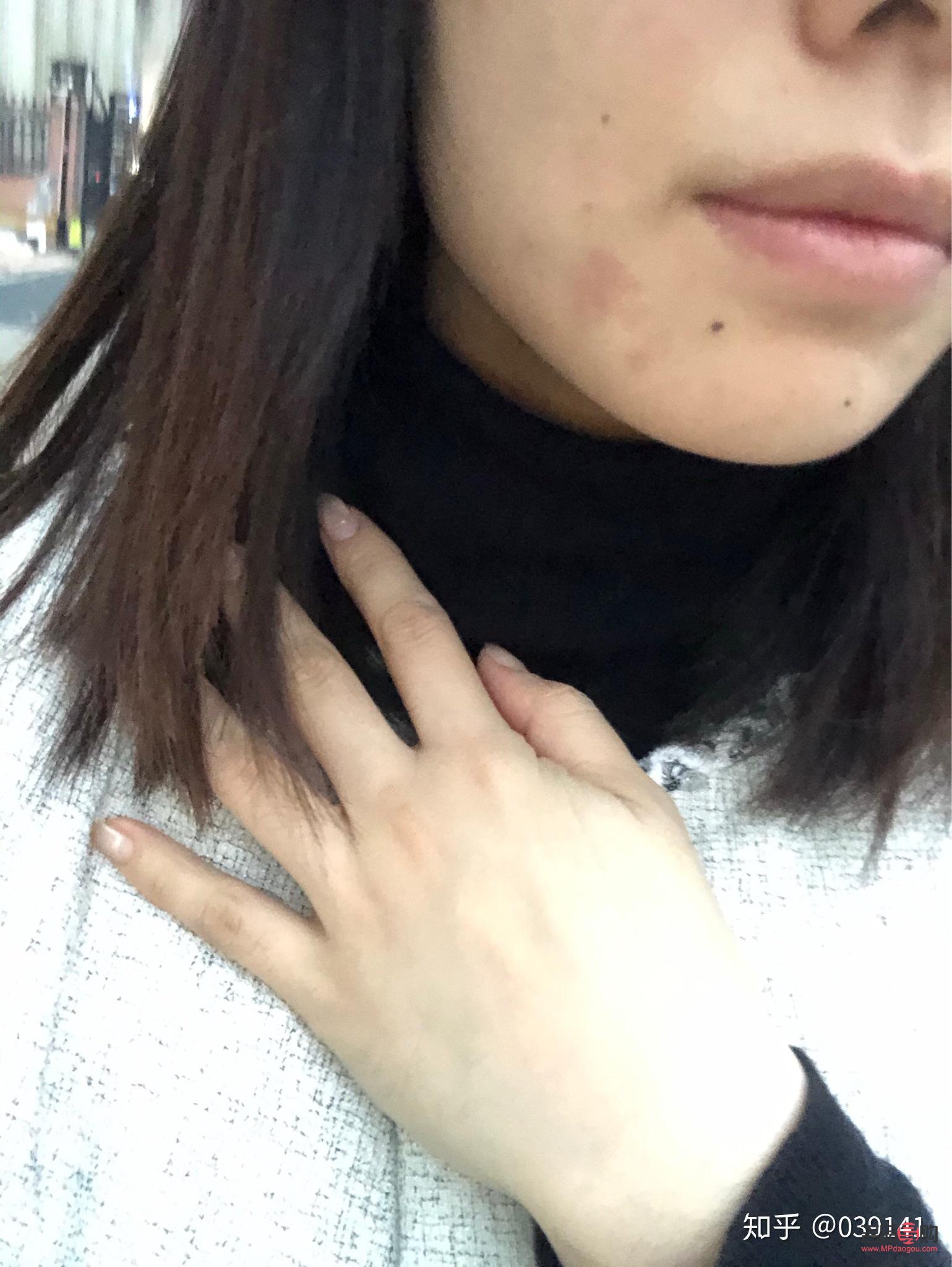 眼角回包手术过程多久(眼角回包手术过程多久恢复) 眼角回包手术过程多久(眼角回包手术过程多久恢复)