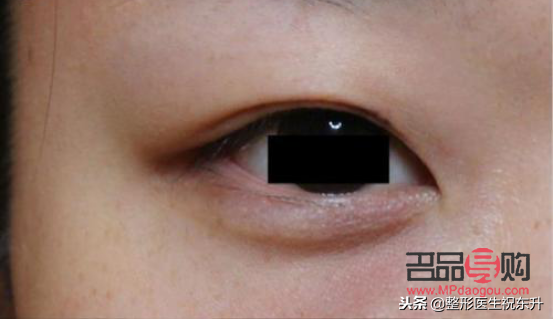 什么双眼皮最好看最自然(什么双眼皮最好看最自然的)