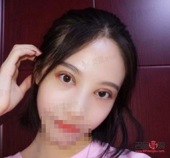 7.5毫米双眼皮恢复图片(7.5毫米双眼皮恢复图片大全)