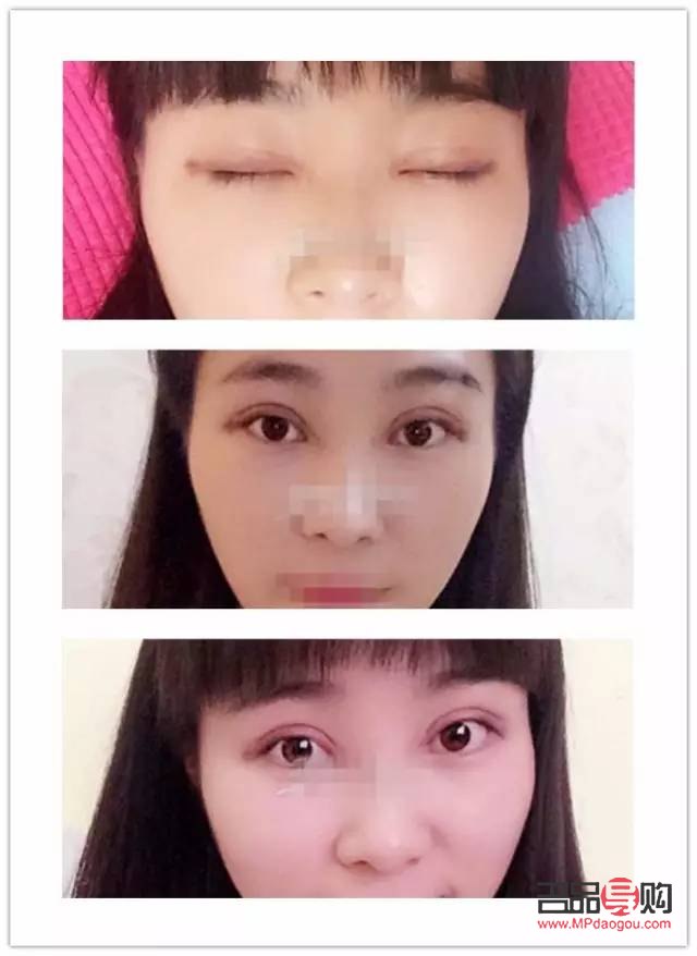 7.5毫米双眼皮恢复图片(7.5毫米双眼皮恢复图片大全)