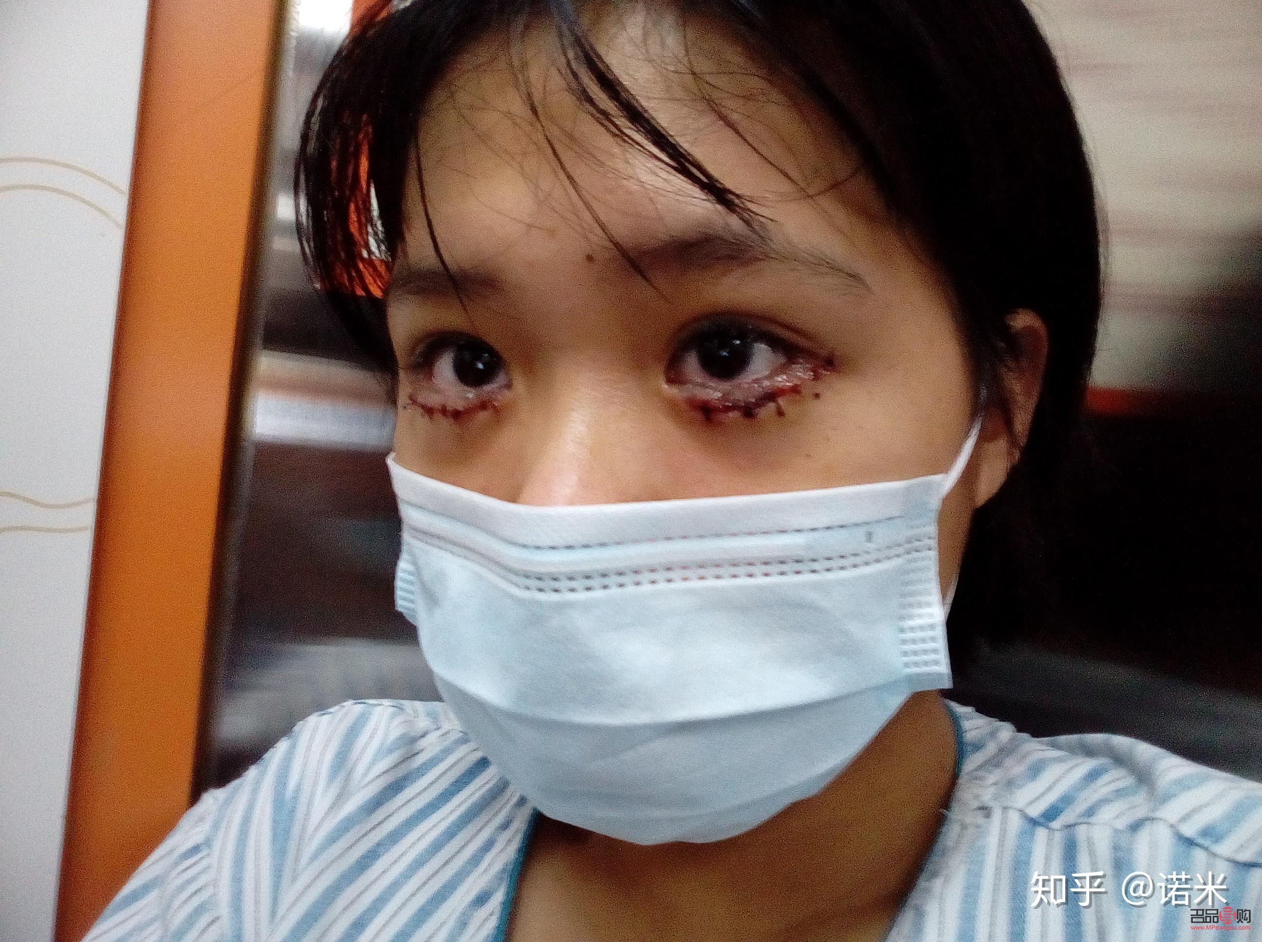 眼睛倒睫手术后会留疤吗(眼睛倒睫手术后会留疤吗图片)