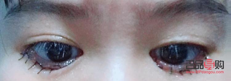 眼睛倒睫手术后会留疤吗(眼睛倒睫手术后会留疤吗图片)