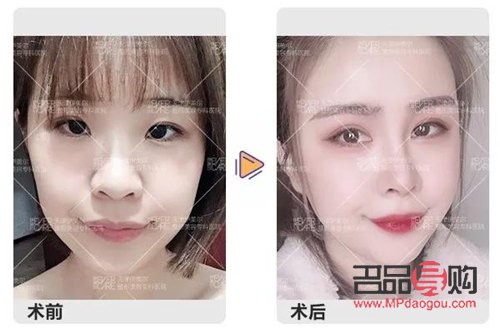 翘睫双眼皮是永久的吗怎么做(翘睫双眼皮是永久的吗怎么做手术)