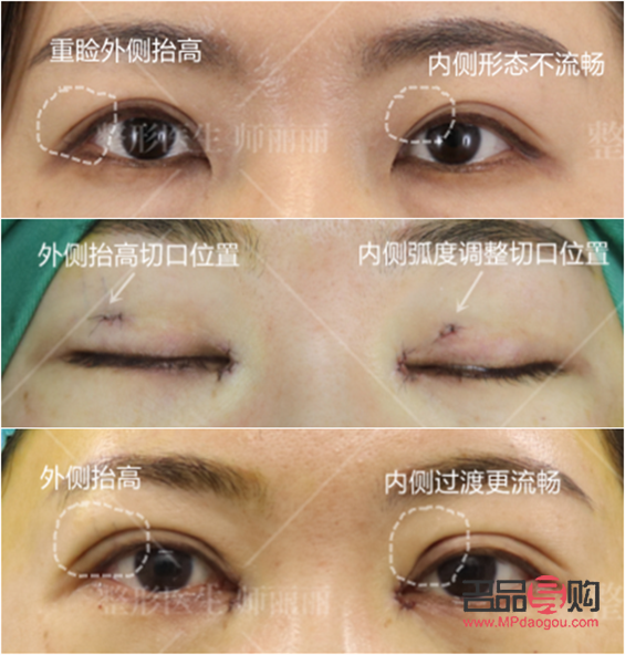 做什么双眼皮恢复快(做什么双眼皮恢复快能保持永久)