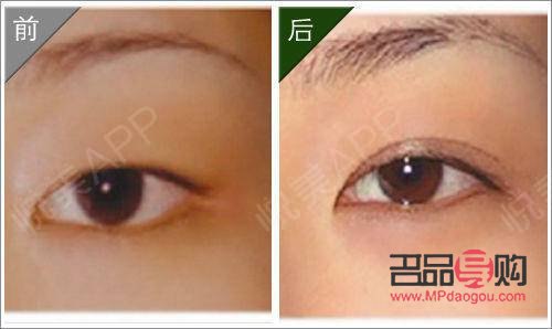 <h3>内双如何埋线打造双眼皮魅力</h3> <h3>内双如何埋线打造双眼皮魅力</h3>