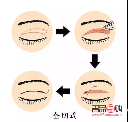 <h3>内双如何埋线打造双眼皮魅力</h3> <h3>内双如何埋线打造双眼皮魅力</h3>