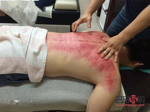 刮痧后的身体护理之道