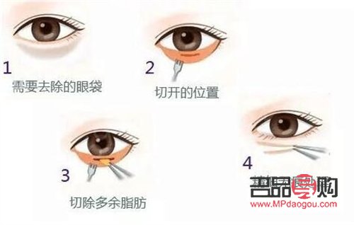去泪沟眼袋手术费用知多少