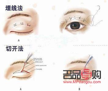 割双眼皮手术前需要注意什么(割双眼皮手术前需要注意什么事项)