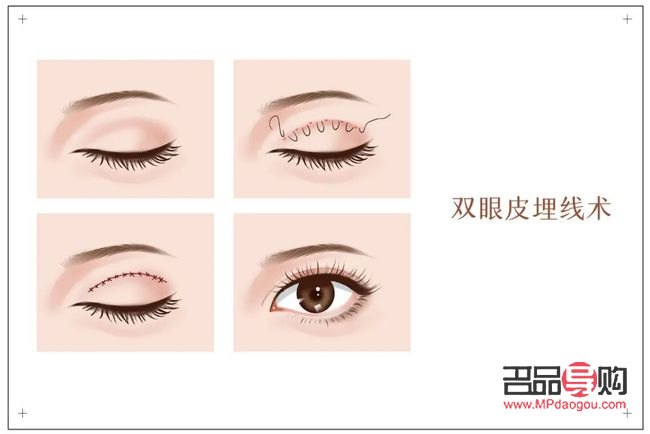 双眼皮哪一种手术更好看(双眼皮哪一种手术更好看些)