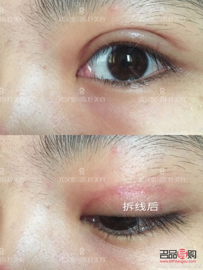 美容线拆线痛吗(美容线拆线痛吗多少钱) 美容线拆线痛吗(美容线拆线痛吗多少钱)