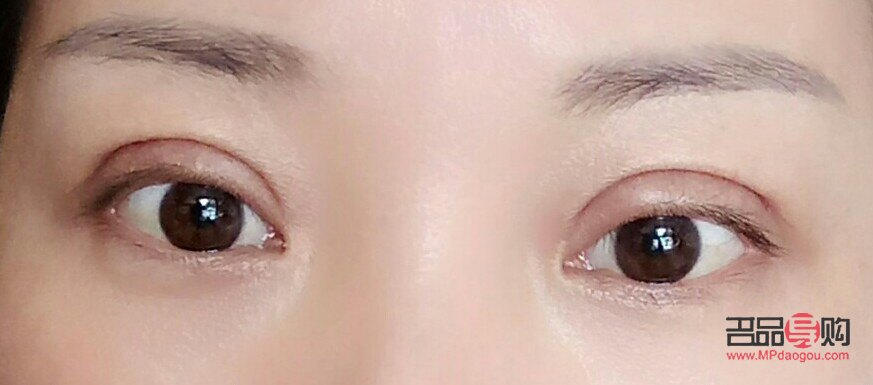 割双眼皮二十天后的图片(割完双眼皮二十天的图片)