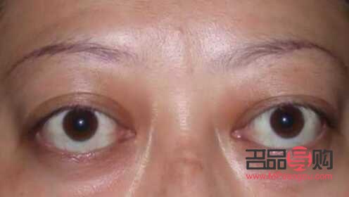 甲亢眼睛和正常人眼睛(眼球突出与正常眼图片)