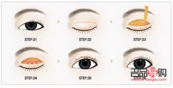 双眼皮割深了怎么办？专业修复与后期护理全解析