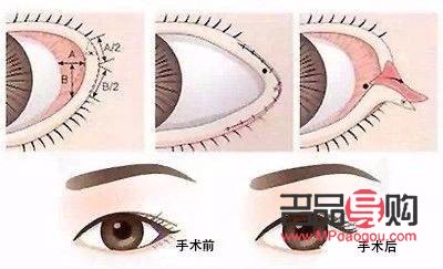 开眼角手术：塑造明亮大眼的新选择