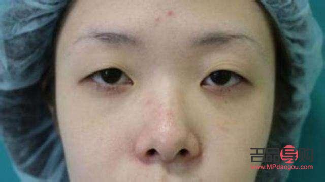 右眼眼皮耷拉下来了究竟怎么回事(右眼眼皮耷拉下来了究竟怎么回事儿)