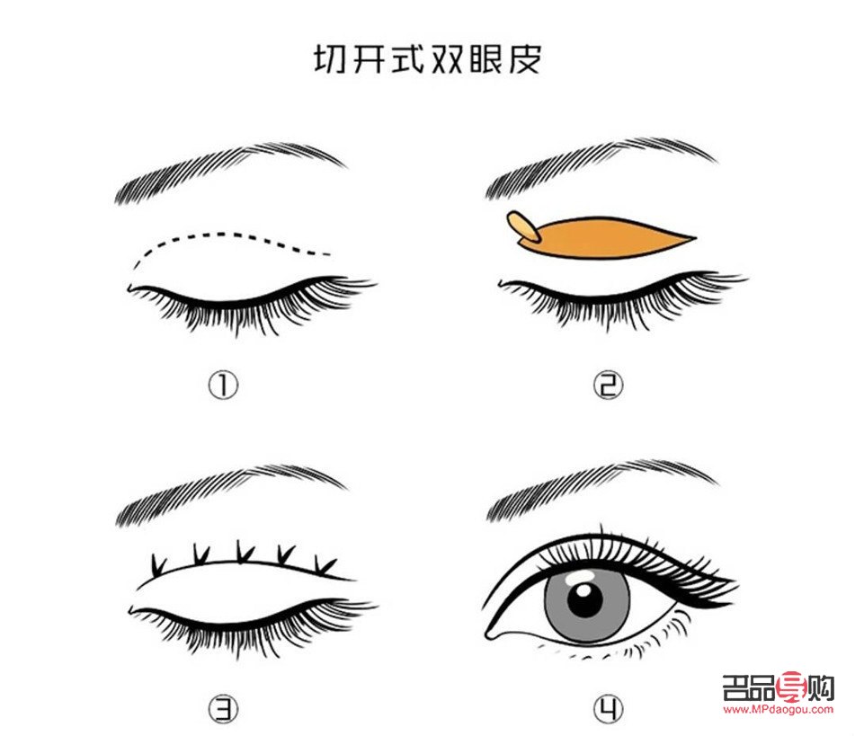 全切双眼皮的弊端深度解析