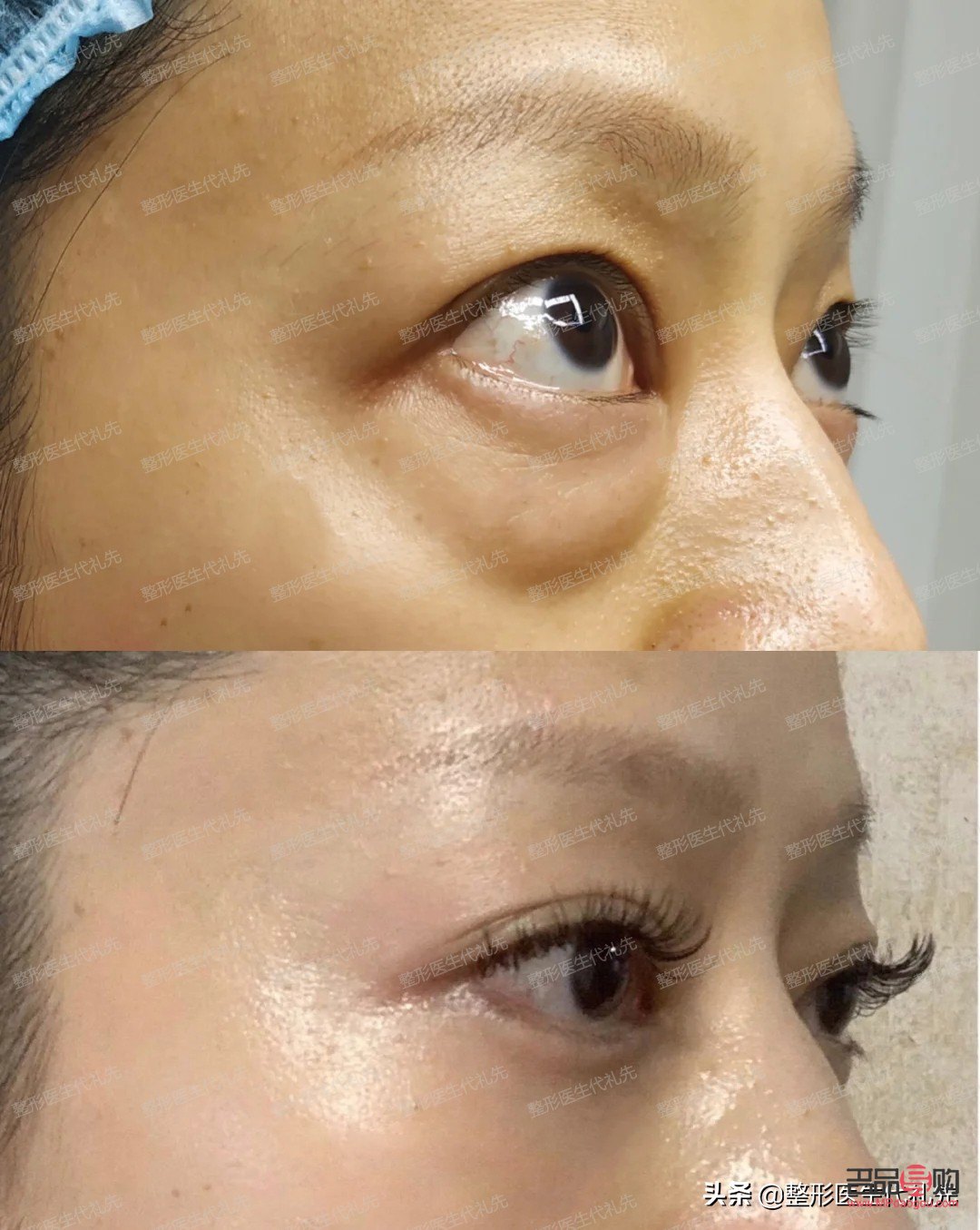 眼袋和泪沟一起做手术可以吗(眼袋和泪沟一起做手术可以吗多少钱)