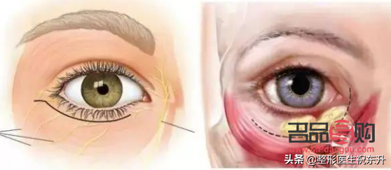 眼袋和泪沟一起做手术可以吗(眼袋和泪沟一起做手术可以吗多少钱)