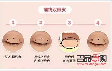 双眼皮有三条线 是什么原因(双眼皮有三条线 是什么原因造成的)