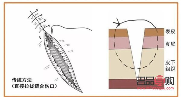 美容缝合留疤吗(美容缝合留疤吗会留疤吗)