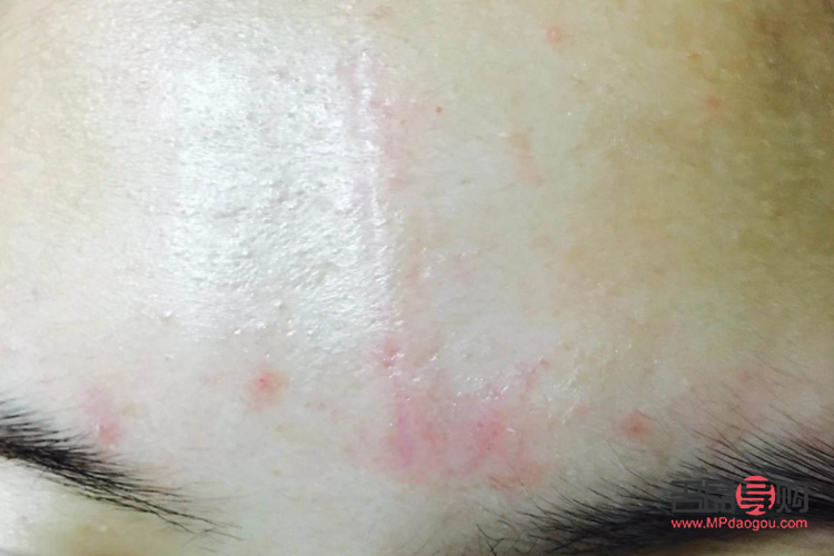 美容缝合留疤吗(美容缝合留疤吗会留疤吗)