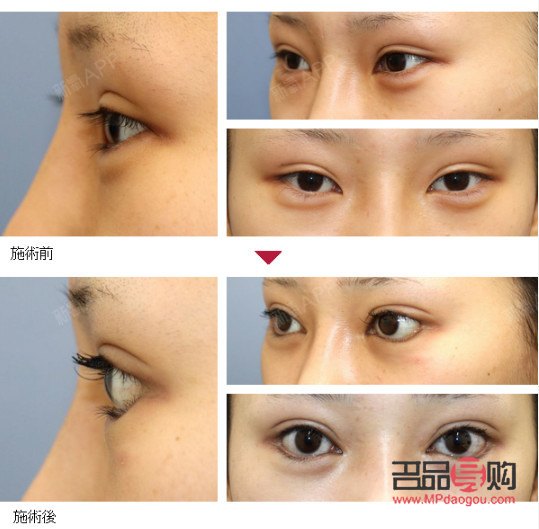 <h1>眼部综合术：重塑明亮双眸的全方位解决方案</h1>